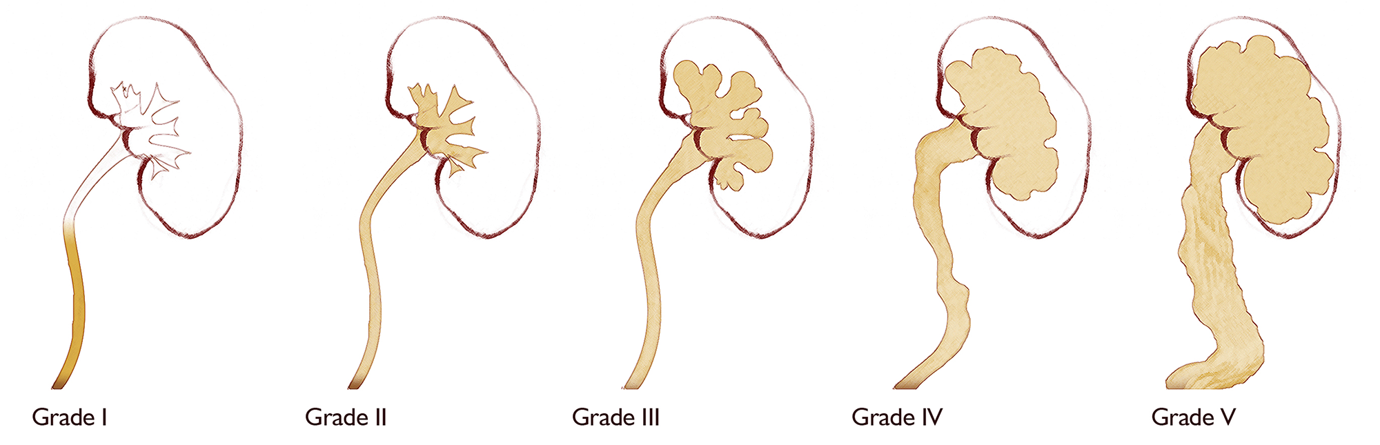 urinary reflux grades